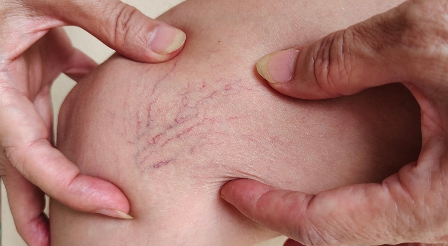 Photo - 0 - Vein Disease Explained