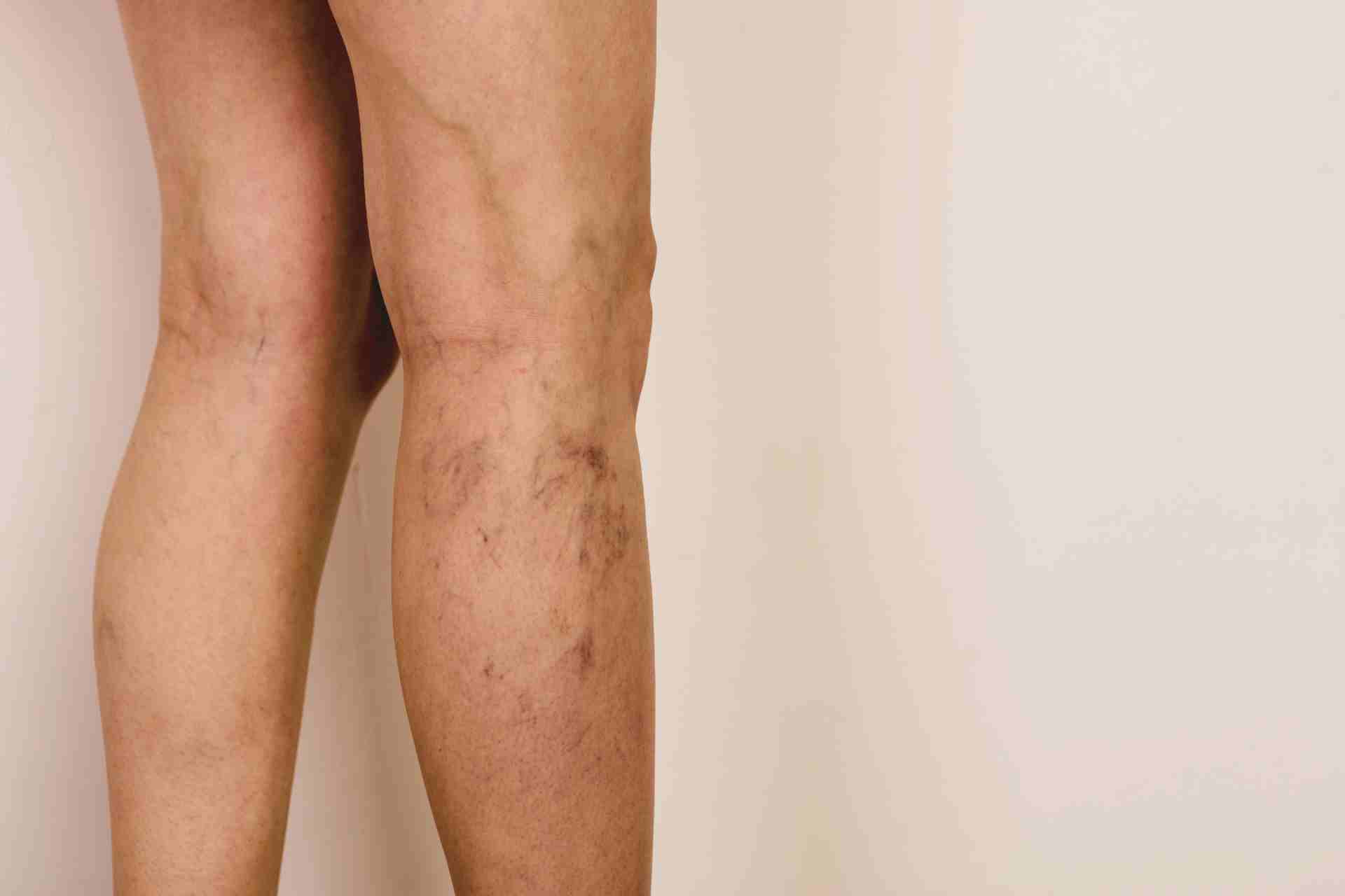 Photo - 0 - Purple Skin Discoloration on Legs