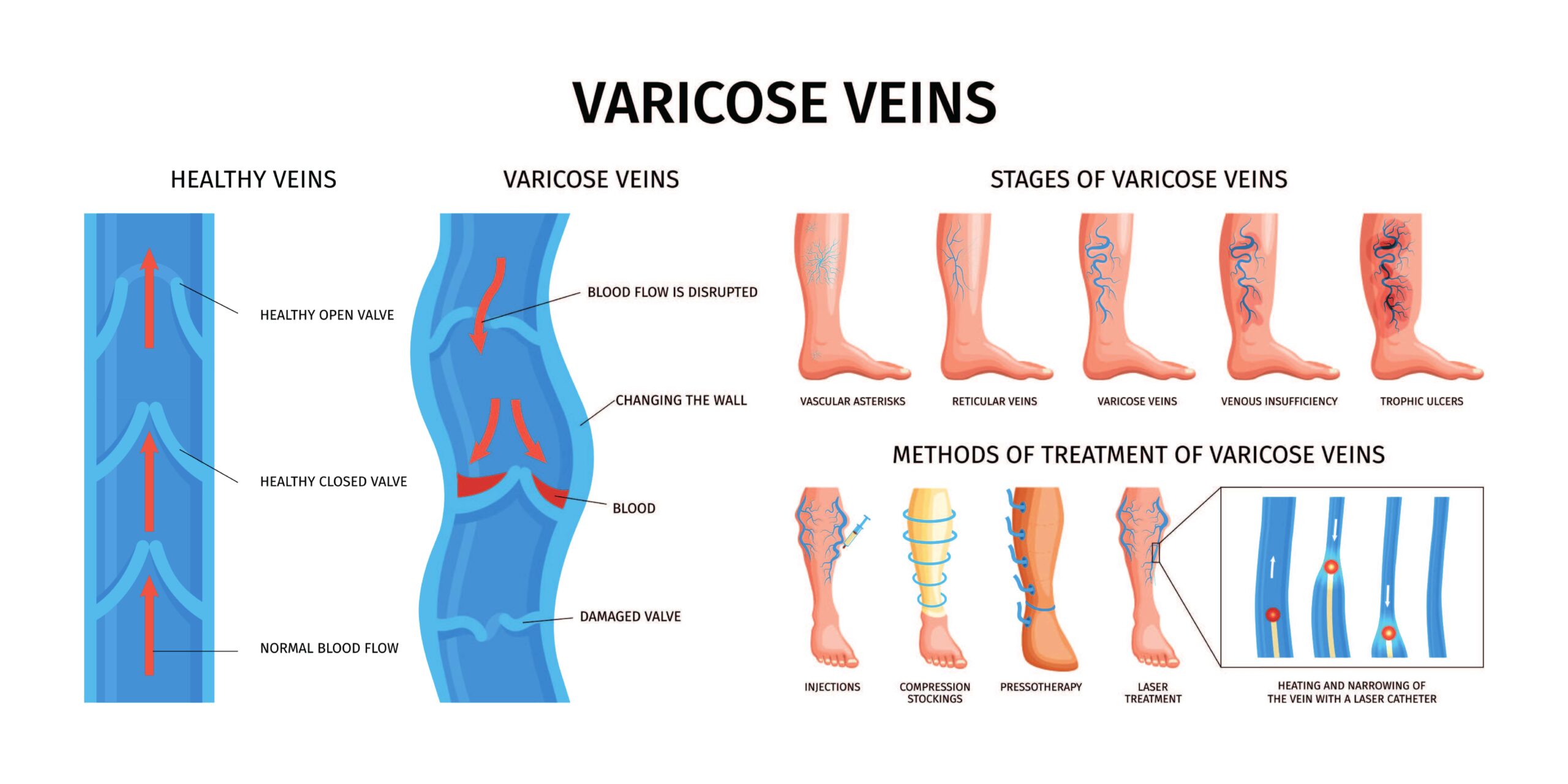 Photo - 0 - What Happens If You Ignore Varicose Veins?