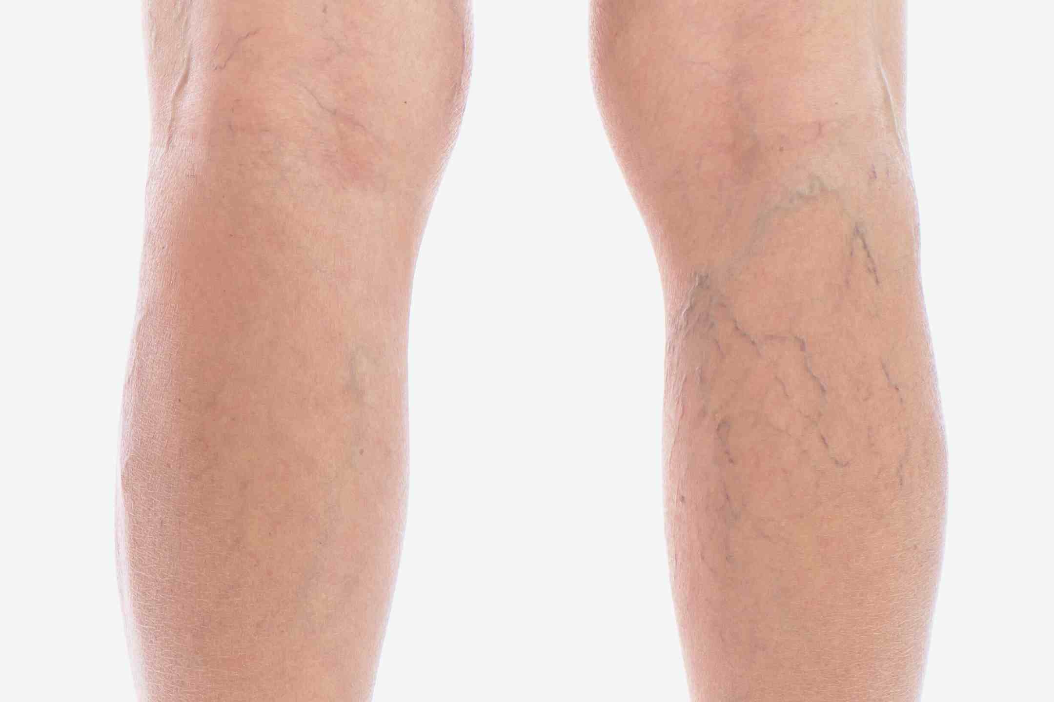 Photo - 0 - Why Are My Veins Blue?