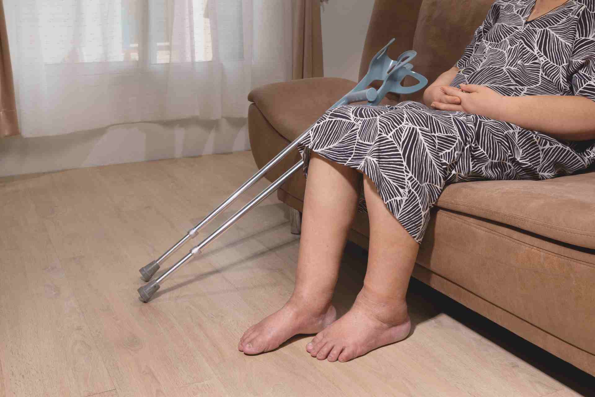 Photo - 0 - What Is Heat Edema?