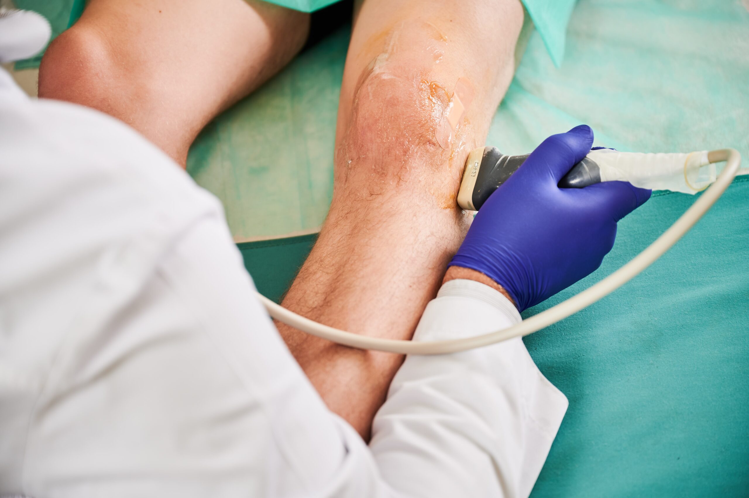 Photo - 0 - What Causes Veins to Pop Out in Arms and Hands?