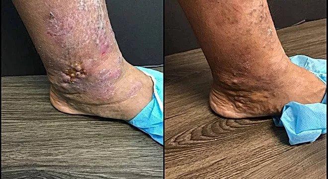 Left medial ankle ulceration before and after treatment with radiofrequency ablation and Varithena