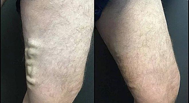 Large varicose veins on the inner thigh before and after radiofrequency ablation and Varithena treatment