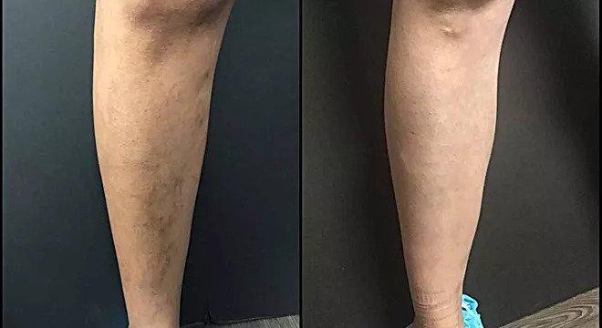 Varicose veins in the lower calf before and after radiofrequency ablation and foam sclerotherapy