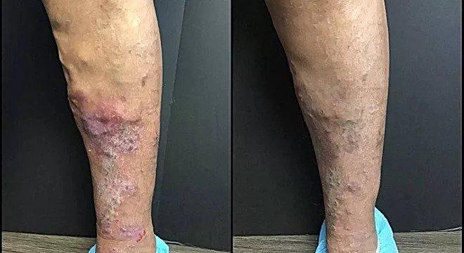 Eczema and pigmentation changes from chronic venous insufficiency before and after radiofrequency ablation and Varithena