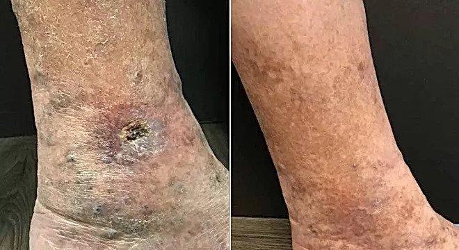 Pigmentation and active ulceration healed after treatment with radiofrequency ablation and foam sclerotherapy