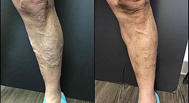 Prominent calf varicose veins in a soccer player before and after radiofrequency ablation and Varithena